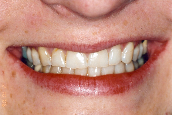 Pre Cosmetic Dentistry - Finsbury Dental Care