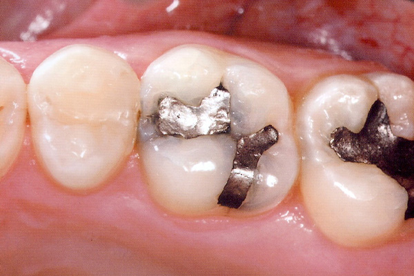 Before Dental Fillings - Finsbury Dental Care