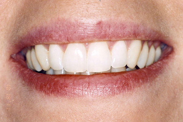 After Invisalign Treatment - Finsbury Dental