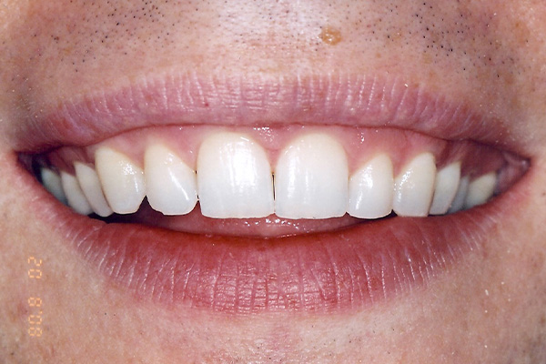 Orthodontic Treatments - Finsbury Dental